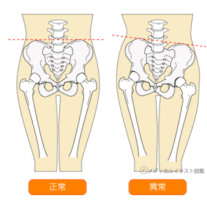 骨盤の歪み